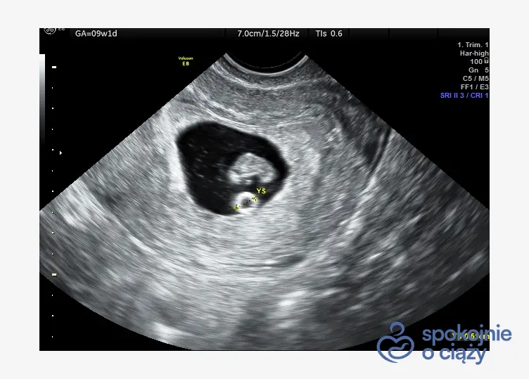 Obraz pęcherzyka ciążowego, w środku zmierzony pęcherzyk żółtkowy (YS) oraz zarodek