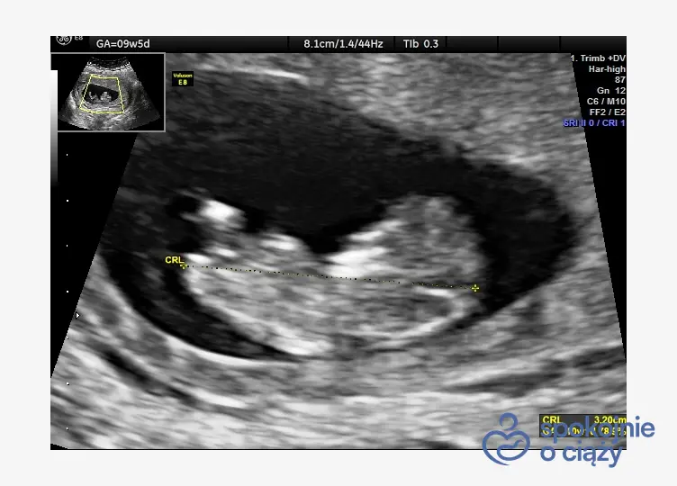 Zarodek długości 32 mm w 10.1 hbd (dziesiąty tydzień, pierwszy dzień), według OM (ostatniej miesiączki) 9.5 hbd (9 tydzień piąty dzień)