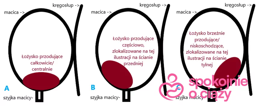 Nieprawidłowa lokalizacja łożyska w ciąży.