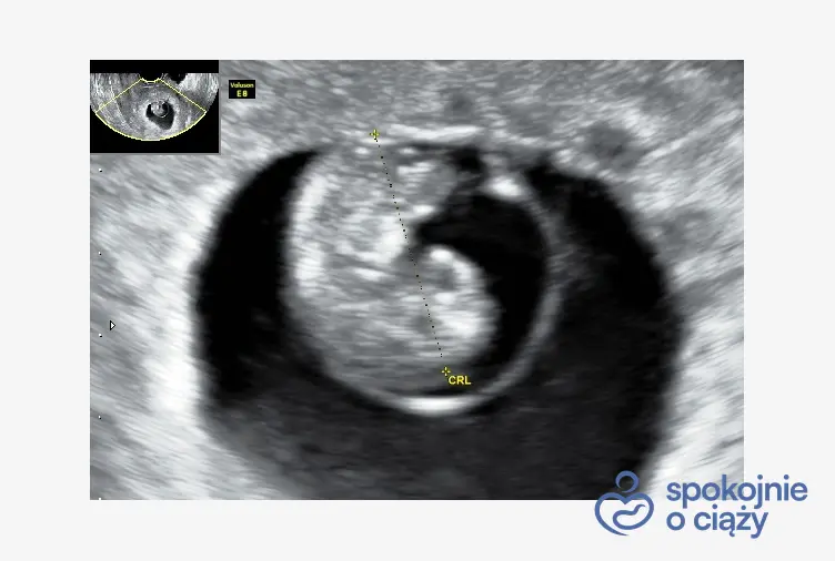 Zarodek w 8 tygodniu ciąży