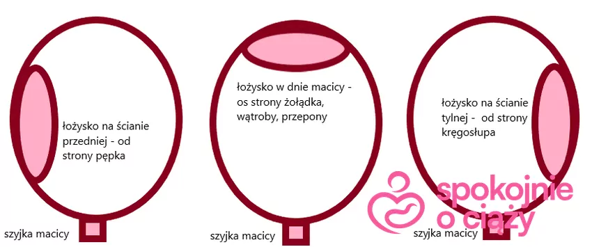 Prawidłowe lokalizacje łożyska - na ścianie przedniej, w dnie, na ścianie tylnej Prawidłowe lokalizacje łożyska w macicy