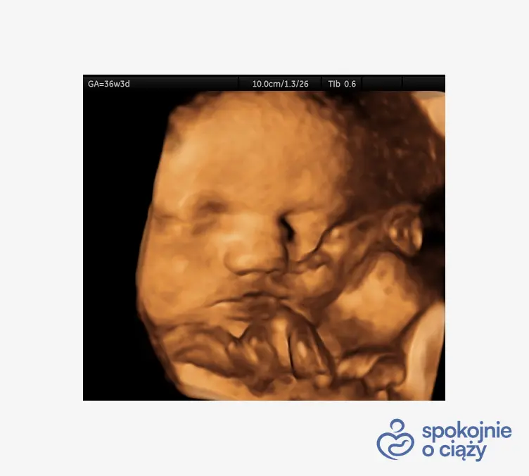 Pępowina dwunaczyniowa widoczna przed buzią dziecka w USG 3D