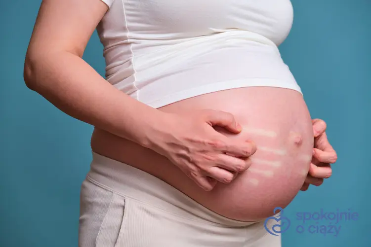 Kobieta w zaawansowanej ciąży drapiąca brzuch, a także swędzenie skóry w ciąży