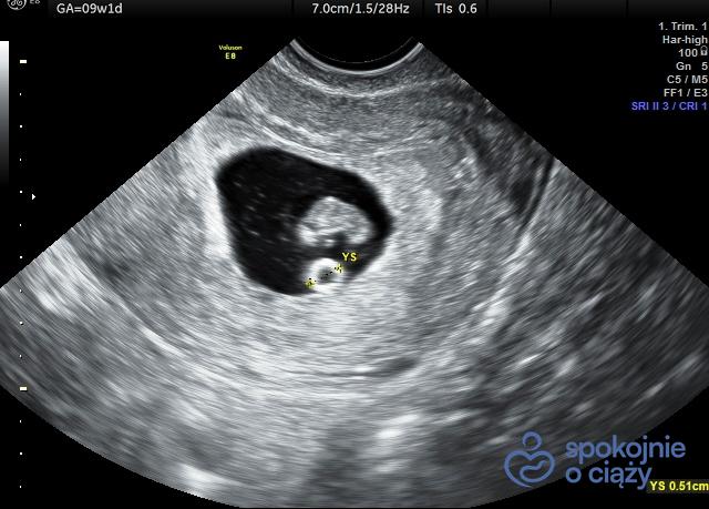 Obraz pęcherzyka ciążowego, w środku zmierzony pęcherzyk żółtkowy (YS) oraz zarodek