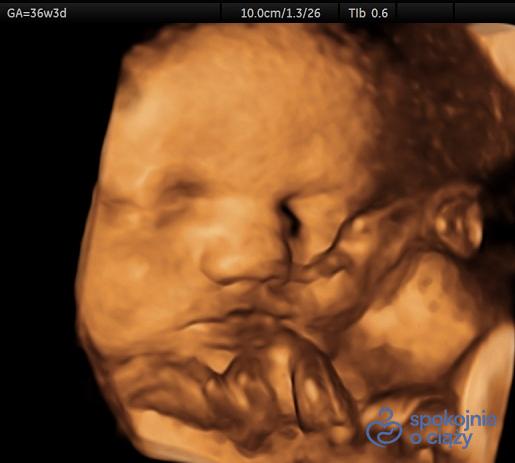 Pępowina dwunaczyniowa widoczna przed buzią dziecka w USG 3D