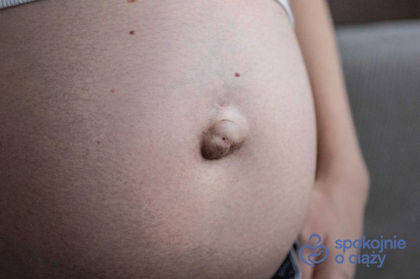 Przepuklina pępkowa u kobiety w ciąży, a także przyczyny i objawy przepukliny pępkowej