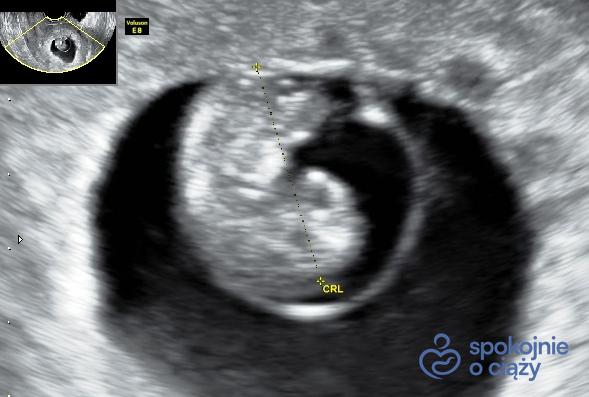 Zarodek w 8 tygodniu ciąży na obrazie USG oraz pierwsze USG w ciąży